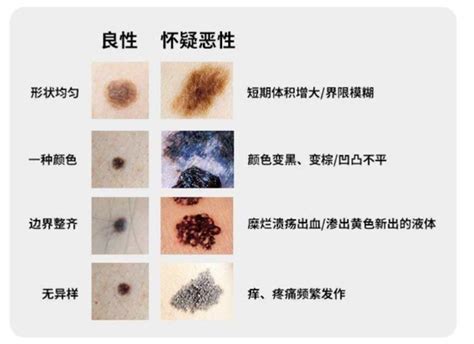 痣上面長痘痘|点痣不正规可能引发癌变：关于痣的 4 个常识